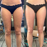 Sheeloo™ - Anti-Cellulite Massager